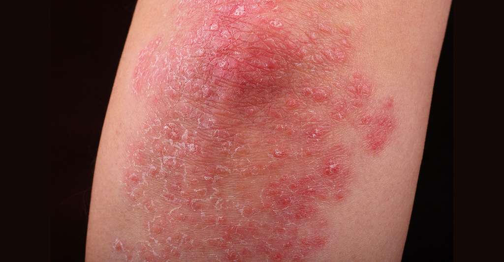 Le psoriasis est une maladie du système immunitaire qui affecte la peau